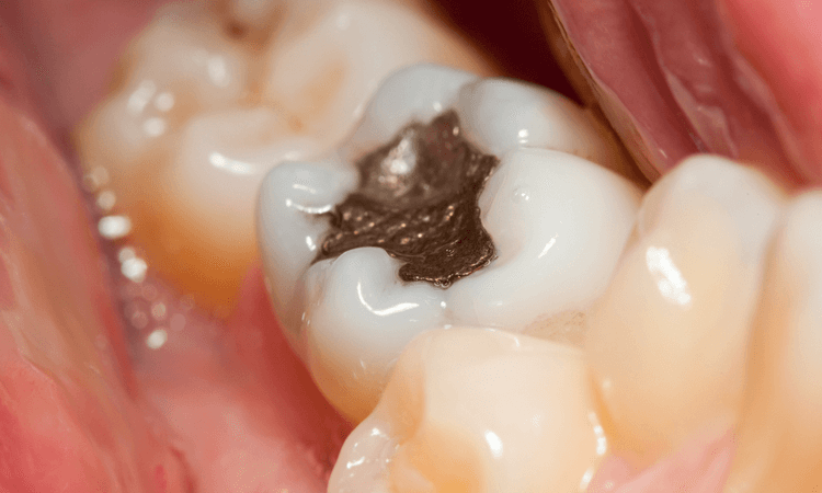 tooth-coloured-fillings